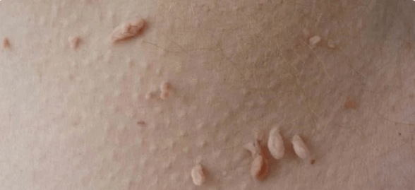 HPV pārraides metode
