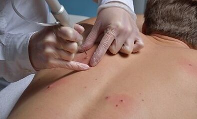 papilomu noņemšanas veidi