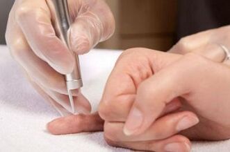 kā atbrīvoties no papillomas uz ķermeņa