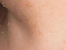 papilomu parādīšanās iemesli uz ķermeņa